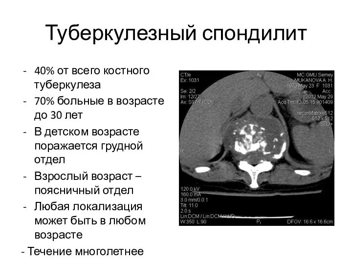 Туберкулезный спондилит 40% от всего костного туберкулеза 70% больные в возрасте до