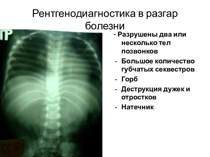 Рентгенодиагностика в разгар болезни - Разрушены два или несколько тел позвонков Большое