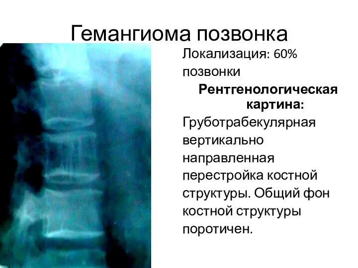 Гемангиома позвонка Локализация: 60% позвонки Рентгенологическая картина: Груботрабекулярная вертикально направленная перестройка костной