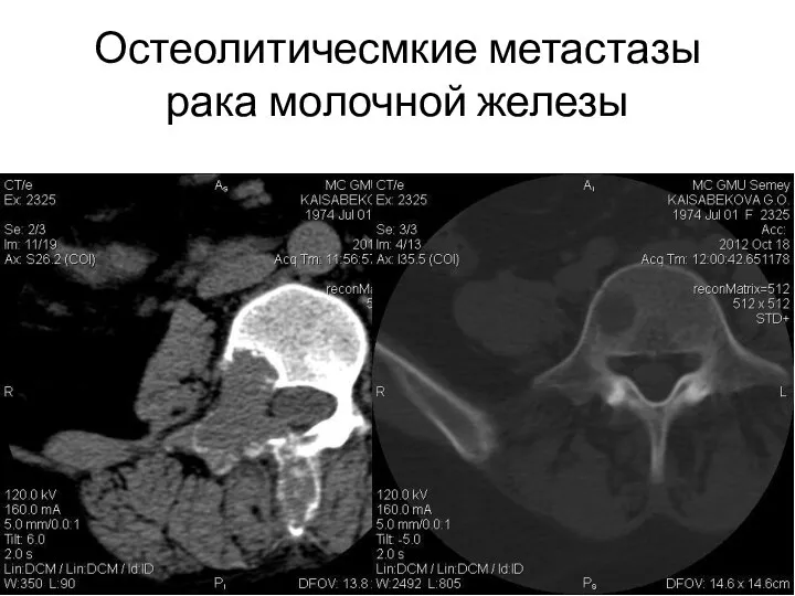 Остеолитичесмкие метастазы рака молочной железы