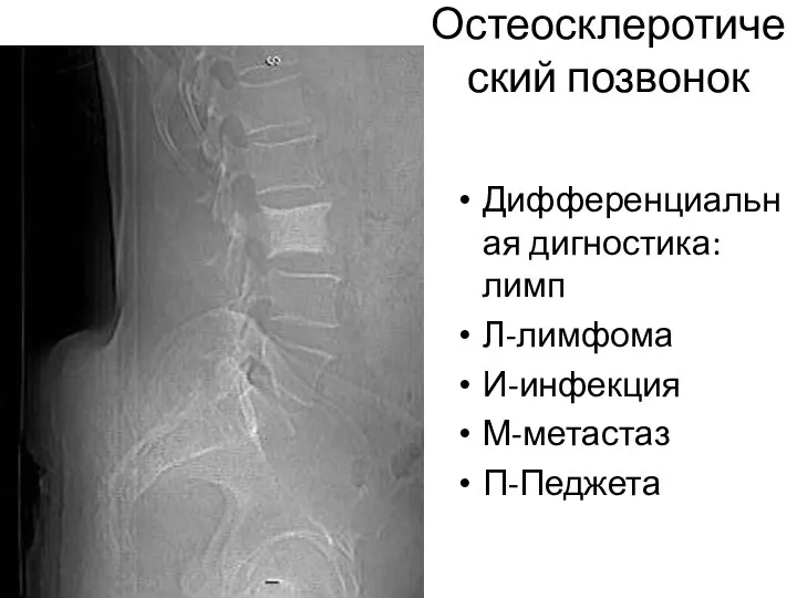 Остеосклеротический позвонок Дифференциальная дигностика: лимп Л-лимфома И-инфекция М-метастаз П-Педжета