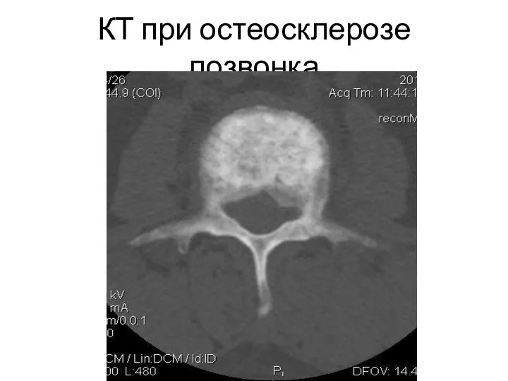 КТ при остеосклерозе позвонка