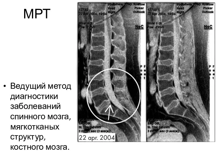 МРТ Ведущий метод диагностики заболеваний спинного мозга, мягкотканых структур, костного мозга.