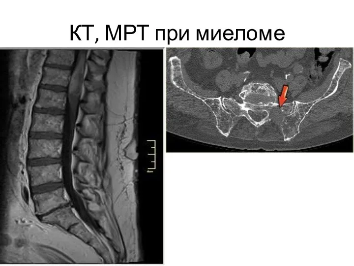 КТ, МРТ при миеломе