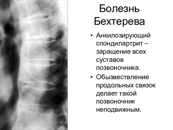 Болезнь Бехтерева Анкилозирующий спондилартрит – заращение всех суставов позвоночника. Обызвествление продольных связок делает такой позвоночник неподвижным.