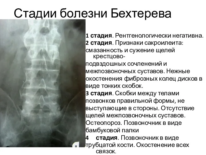 Стадии болезни Бехтерева 1 стадия. Рентгенологически негативна. 2 стадия. Признаки сакроилеита: смазанность