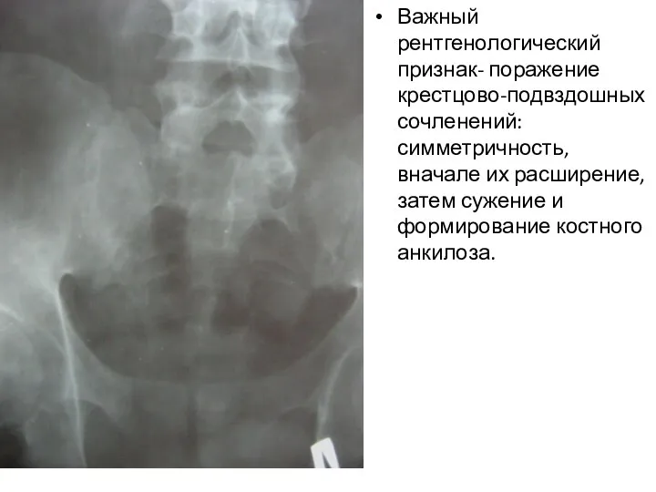 Важный рентгенологический признак- поражение крестцово-подвздошных сочленений: симметричность, вначале их расширение, затем сужение и формирование костного анкилоза.