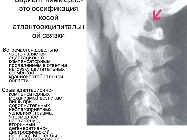 Вариант Киммерле-это оссификация косой атлантоокципитальной связки Встречается довольно часто является адаптационно-компенсаторным проявлением