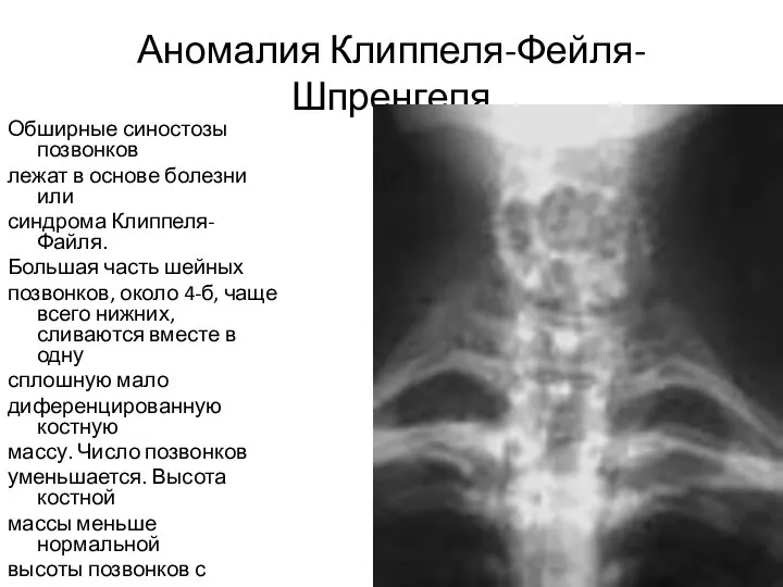 Аномалия Клиппеля-Фейля-Шпренгеля Обширные синостозы позвонков лежат в основе болезни или синдрома Клиппеля-Файля.