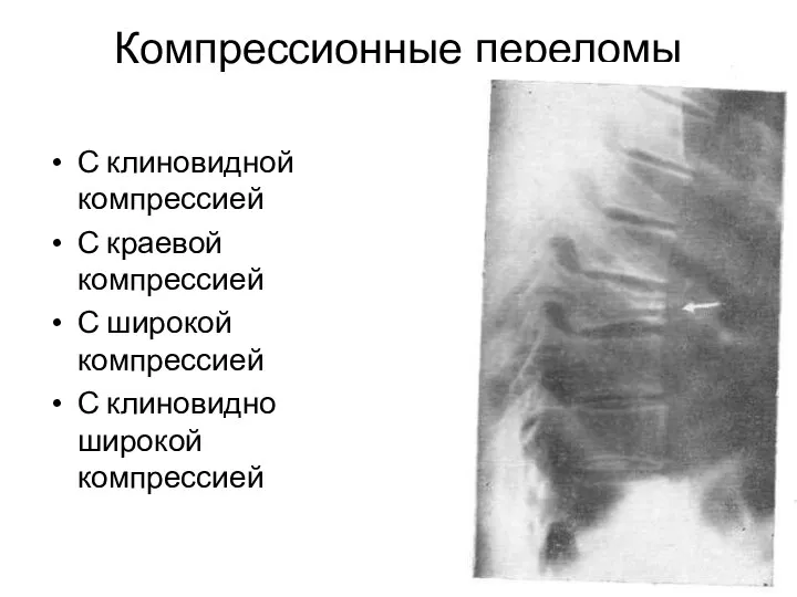 Компрессионные переломы С клиновидной компрессией С краевой компрессией С широкой компрессией С клиновидно широкой компрессией