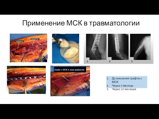 Применение МСК в травматологии До внесения графта с МСК Через 3 месяца Через 12 месяцев