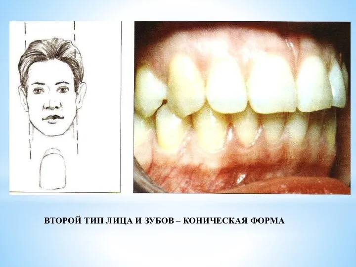 ВТОРОЙ ТИП ЛИЦА И ЗУБОВ – КОНИЧЕСКАЯ ФОРМА