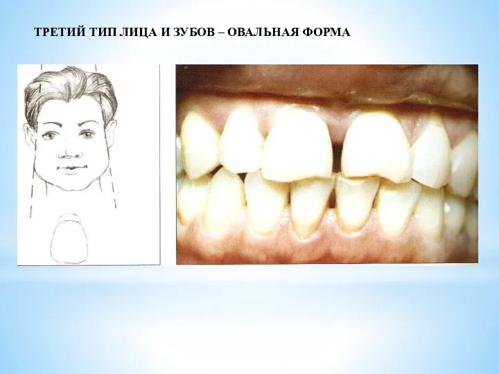 ТРЕТИЙ ТИП ЛИЦА И ЗУБОВ – ОВАЛЬНАЯ ФОРМА
