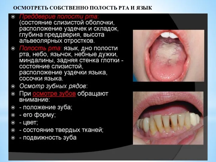 ОСМОТРЕТЬ СОБСТВЕННО ПОЛОСТЬ РТА И ЯЗЫК