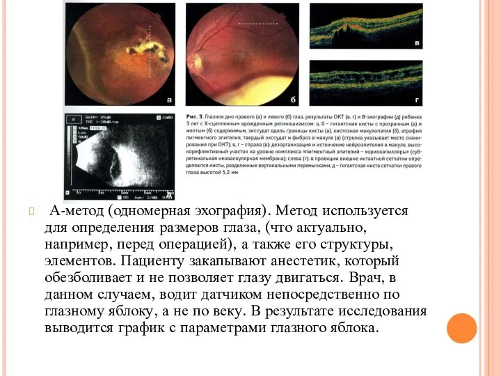 А-метод (одномерная эхография). Метод используется для определения размеров глаза, (что актуально, например,