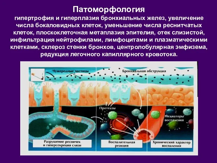 Патоморфология гипертрофия и гиперплазия бронхиальных желез, увеличение числа бокаловидных клеток, уменьшение числа