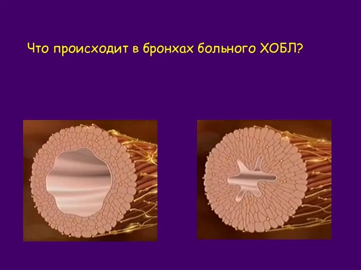 Что происходит в бронхах больного ХОБЛ? Просвет бронха у здорового человека Просвет бронха при ХОБЛ