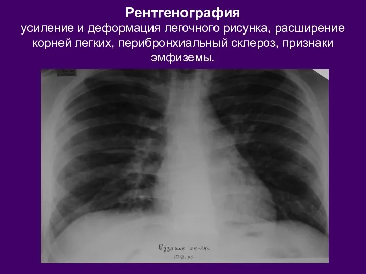 Рентгенография усиление и деформация легочного рисунка, расширение корней легких, перибронхиальный склероз, признаки эмфиземы.