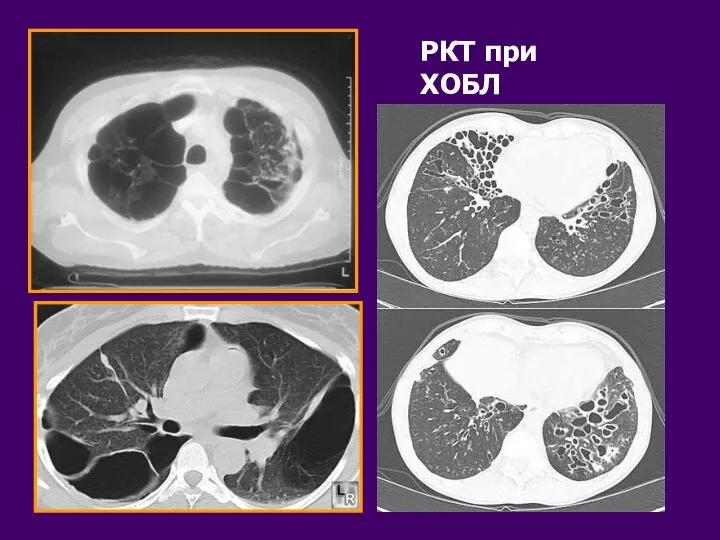 РКТ при ХОБЛ
