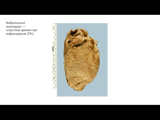 Фибринозный эндокардит — следствие уремии при нефроциррозе (ПН)