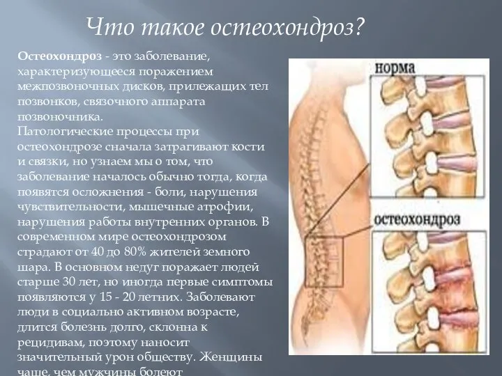 Что такое остеохондроз? Остеохондроз - это заболевание, характеризующееся поражением межпозвоночных дисков, прилежащих