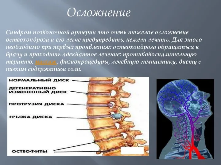 Синдром позвоночной артерии это очень тяжелое осложнение остеохондроза и его легче предупредить,