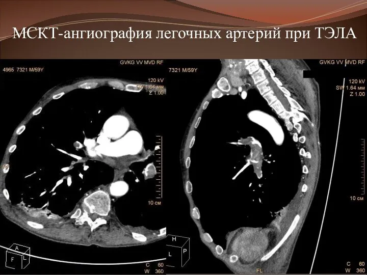 МСКТ-ангиография легочных артерий при ТЭЛА