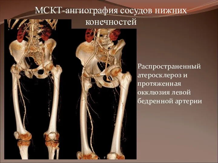 МСКТ-ангиография сосудов нижних конечностей Распространенный атеросклероз и протяженная окклюзия левой бедренной артерии