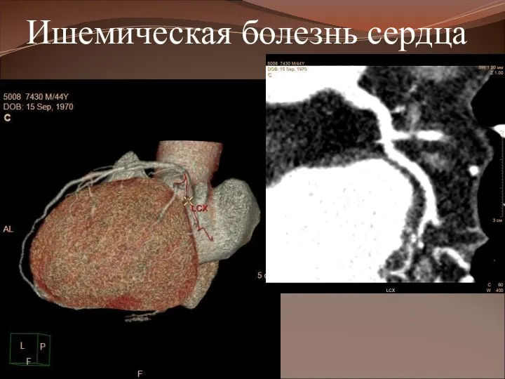 Ишемическая болезнь сердца