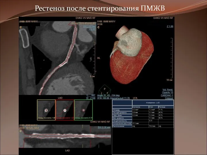 Рестеноз после стентирования ПМЖВ