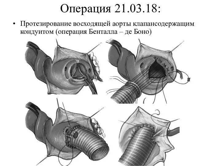 Операция 21.03.18: Протезирование восходящей аорты клапансодержащим кондуитом (операция Бенталла – де Боно)