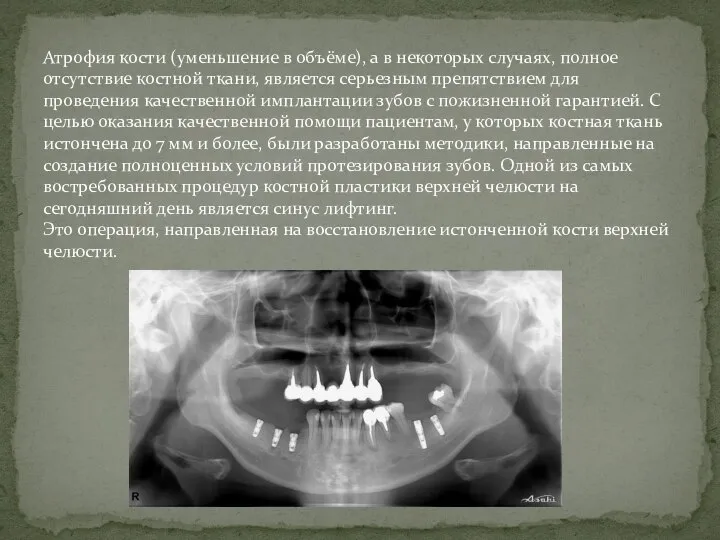 Атрофия кости (уменьшение в объёме), а в некоторых случаях, полное отсутствие костной