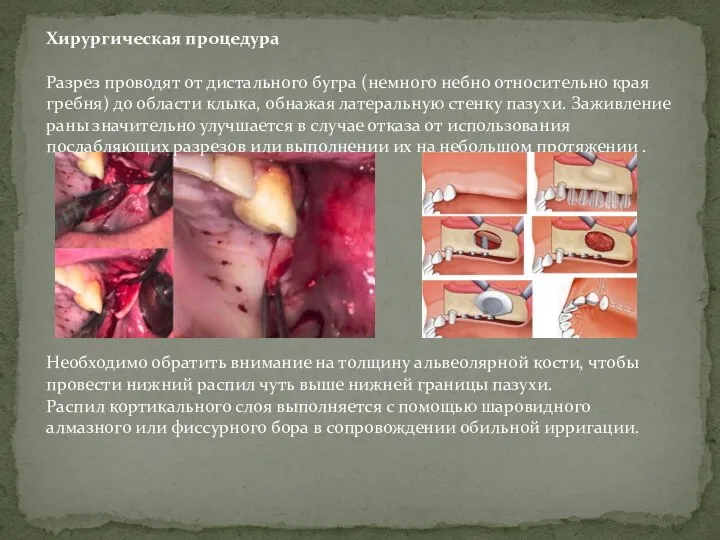 Хирургическая процедура Разрез проводят от дистального бугра (немного небно относительно края гребня)