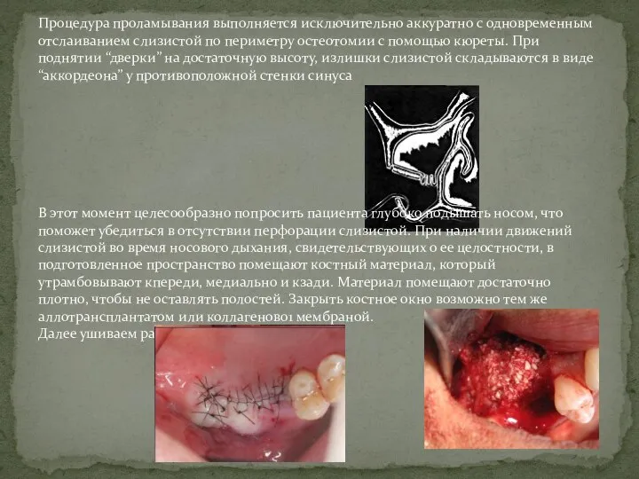 Процедура проламывания выполняется исключительно аккуратно с одновременным отслаиванием слизистой по периметру остеотомии