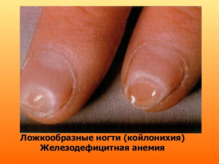 Ложкообразные ногти (койлонихия) Железодефицитная анемия