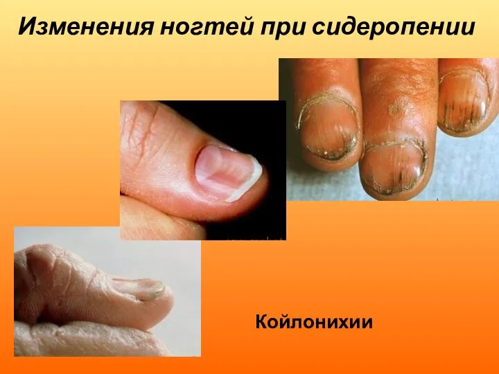 Изменения ногтей при сидеропении Койлонихии