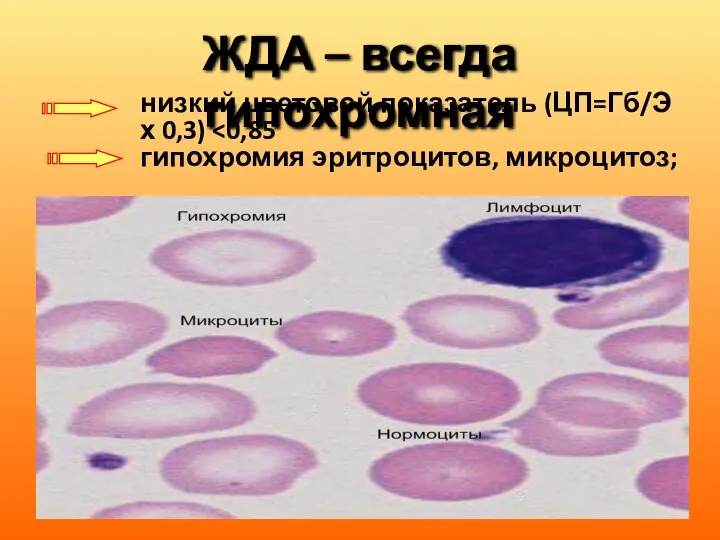 ЖДА – всегда гипохромная низкий цветовой показатель (ЦП=Гб/Э х 0,3) гипохромия эритроцитов, микроцитоз;