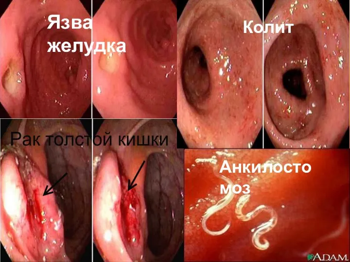 Анкилостомоз Язва желудка Колит