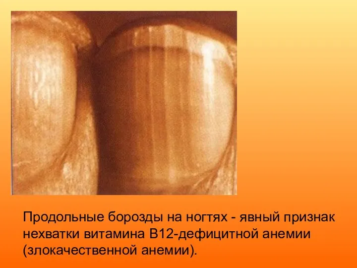 Продольные борозды на ногтях - явный признак нехватки витамина В12-дефицитной анемии (злокачественной анемии).