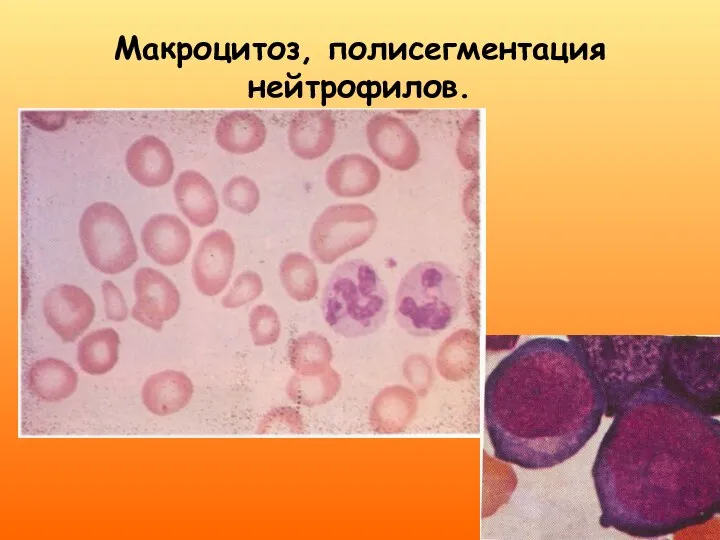 Макроцитоз, полисегментация нейтрофилов.