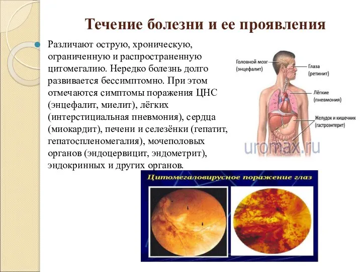 Течение болезни и ее проявления Различают острую, хроническую, ограниченную и распространенную цитомегалию.