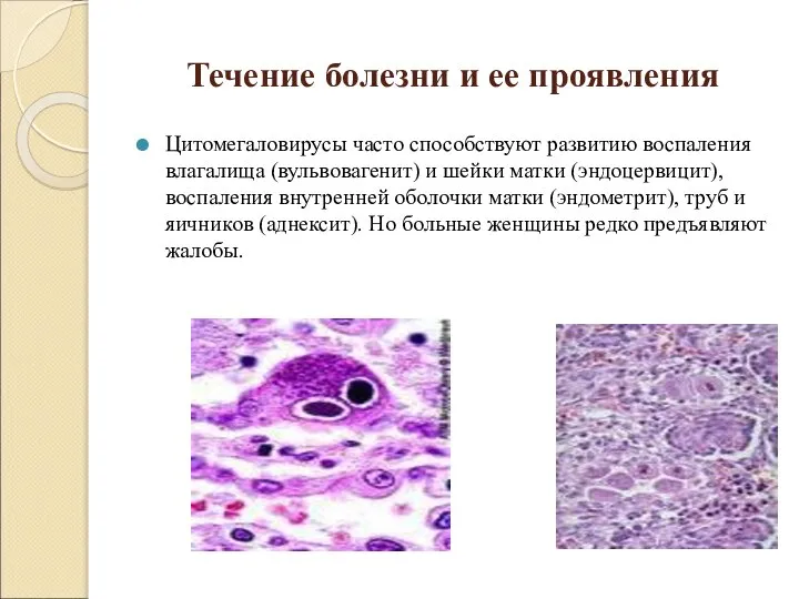 Течение болезни и ее проявления Цитомегаловирусы часто способствуют развитию воспаления влагалища (вульвовагенит)