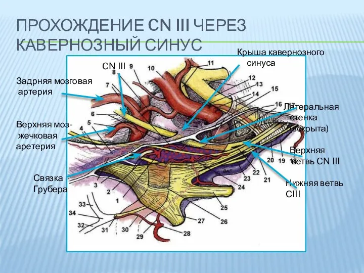 ПРОХОЖДЕНИЕ CN III ЧЕРЕЗ КАВЕРНОЗНЫЙ СИНУС Задрняя мозговая артерия Верхняя моз- жечковая