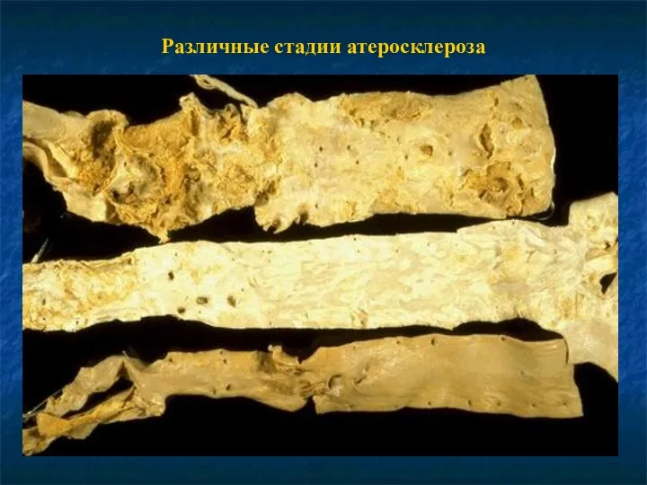 Различные стадии атеросклероза