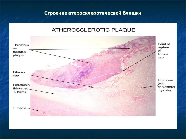 Строение атеросклеротической бляшки