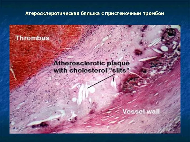Атеросклеротическая бляшка с пристеночным тромбом