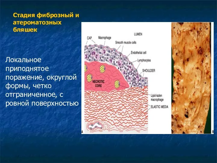 Стадия фиброзный и атероматозных бляшек Локальное приподнятое поражение, округлой формы, четко отграниченное, с ровной поверхностью