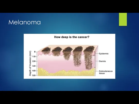 Melanoma