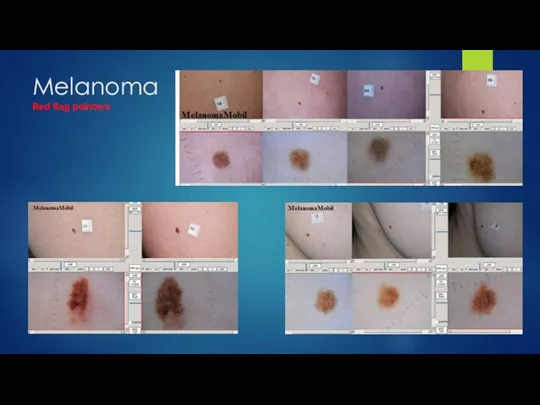 Melanoma Red flag pointers