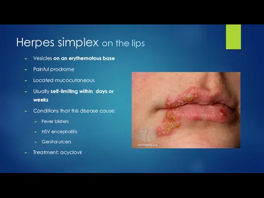 Herpes simplex on the lips Vesicles on an erythematous base Painful prodrome